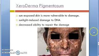 Pathology 761 d Skin XeroDerma Pigmentosum Stratum spinosum pre malignant lesion melanin [upl. by Gebelein824]