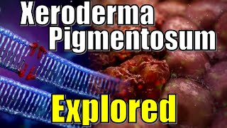 quot Vampire Syndrome quot Xeroderma Pigmentosum DNA Damaged Explained  Effects of UV Radiation on Genes [upl. by Sperry872]