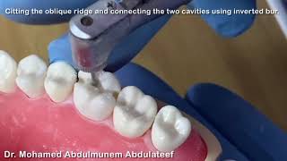 Class II MOD cavity preparation for amalgam restoration in maxillary first molar [upl. by Whitver112]