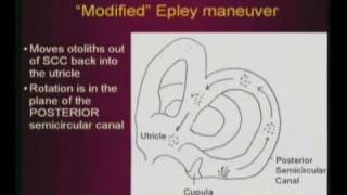 Epley Maneuver [upl. by Tirrag919]