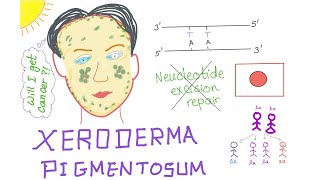 Xeroderma Pigmentosum [upl. by Moia]